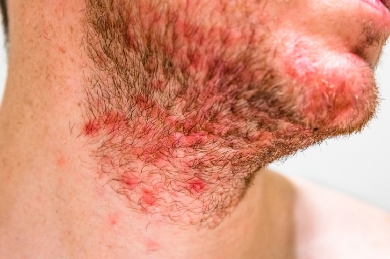 Muž se seboroickou dermatitidou v oblasti brady